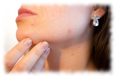 Bild eines Frauengesichts mit Akne als Sinnbild für bessere Hautpflege